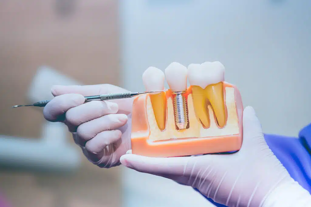 Dental Implants Learning Center — Whitestone Family Dentistry