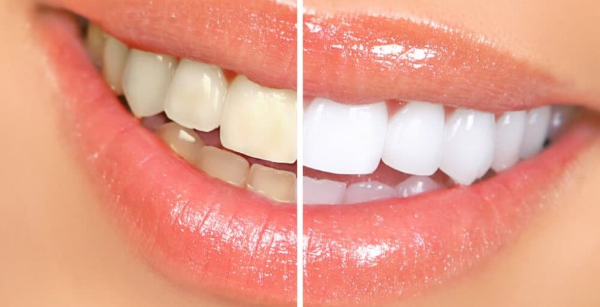 Foods and Drinks to Avoid After Teeth Whitening Treatment